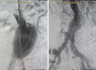 «Корсет» для аневризмы: в Волгограде провели сложную операцию без открытого вмешательства