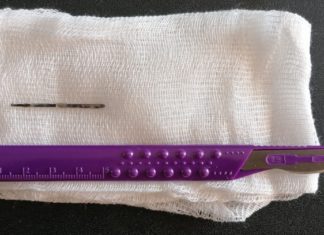 В Волгоградской области женщина 19 лет жила со швейной иглой в животе